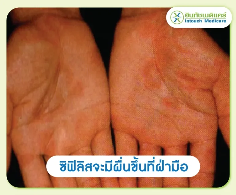 แผลที่ฝ่ามือเป็นอาการของซิฟิลิส