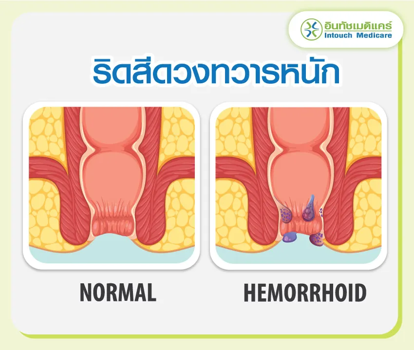 ริดสีดวงทวารหนัก